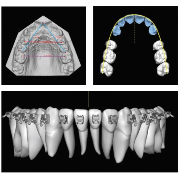 Ortho Insight 3D® Aligner Design and Fabrication Software (22082)